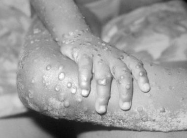 O boală rară extrem de infecţioasă a provocat alertă în SUA. Ce este „variola maimuţei”