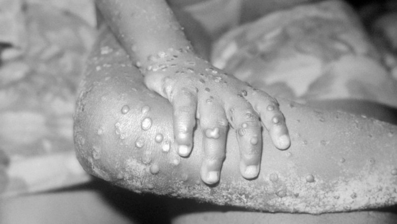 O boală rară extrem de infecţioasă a provocat alertă în SUA. Ce este „variola maimuţei”
