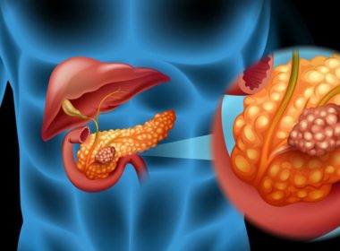 Cancerul pancreatic, evoluţie şi tratament