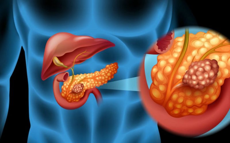 Cancerul pancreatic, evoluţie şi tratament
