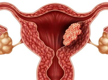 Cancerul de col uterin, un inamic tăcut