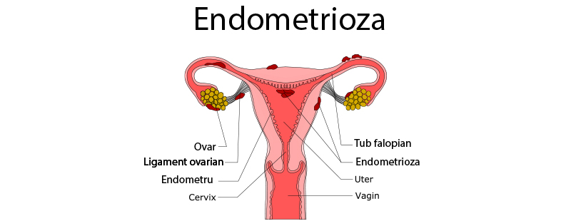 10% dintre femeile din România suferă de endometrioză