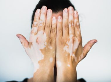 Sănătate cu stil – Tratament laser pentru vitiligo