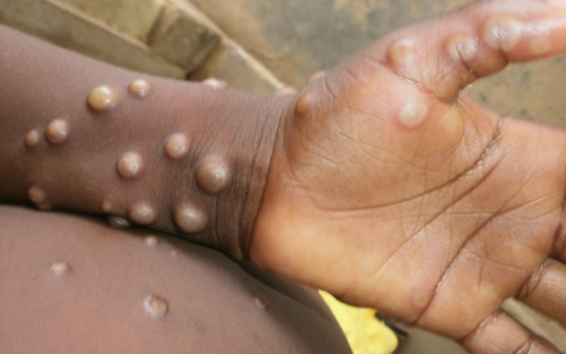 Italia a început vaccinarea împotriva variolei maimuţei